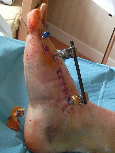 Broches.jpg - 2 jours après l'opération; 3h30 de chirurgie,4 broches, 1 extenseur